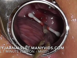 Amatorskie FreyjaanalsLut: Usuwanie jej IUD - wyciągając progress z szyjki macicy Freyji, dzięki czemu pillock płodna ponownie - pełna wersja na Maturevidach
